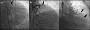 Coronary angiography (Panel A: right caudal view; Panel B: right cranial view) showing LAD occlusion prior to the stent. Panel C: right-sided collaterals filling the distal LAD seen after saphenous vein graft catheterization.