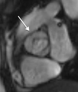 Systolic cine magnetic resonance image of a 36-year-old TS patient, with fusion of the right and left coronary leaflets, with an anterior raphe (white arrow).