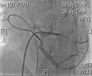 Coronary sinus venography, left anterior oblique view, demonstrating the target posterolateral branch of the coronary sinus.