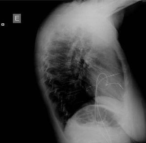 Chest radiograph, lateral view, one day after the procedure.