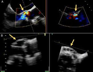 Severe paravalvular leak in the posterior portion of the aortic prosthesis (A, arrow) and pseudoaneurysm with fistulization to the left ventricle and aorta (B, arrow).