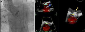 Reduction of paravalvular leak without functional compromise of mechanical prosthesis and confirmation of its stability (A: fluoroscopy; B: transesophageal echocardiography).