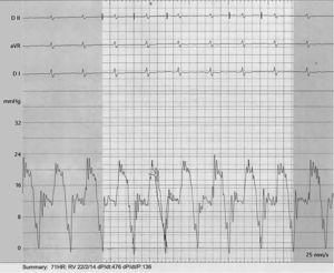 Right heart catheterization. Right ventricular pressure curve with a ‘square root’ pattern, suggestive of early, severely impaired diastolic filling. Note also the elevated v wave, reflecting severe tricuspid regurgitation in a congested right atrium.