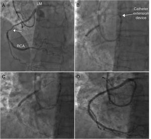 (A) Right coronary angiography showing an anomalous origin and severe stenosis in the middle segment (arrow). (B) Right coronary catheterization using the catheter extension device. (C) Stent delivery. (D) Final angiographic result.