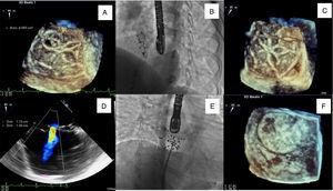 (A and D) Three- (3D TEE) and two-dimensional transesophageal echocardiography images showing residual shunt through the device (22 mm Ultrasept ASD Occluder®); (B and C) delivery sheath through the Ultrasept device in fluoroscopic view and in 3D TEE; (E and F) closure of residual shunt in the 22 mm Ultrasept device with a 20 mm Ultrasept PFO device, with the final result documented in fluoroscopic view and in 3D TEE.