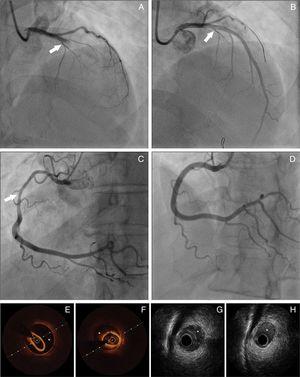 Panel A: Coronary angiography from patient 8 – spontaneous coronary artery dissection (<span class=