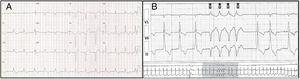 Patient 3: baseline 12-lead electrocardiogram and 24-hour Holter monitoring showing left ventricular hypertrophy (A) and runs of nonsustained ventricular tachycardia (B).