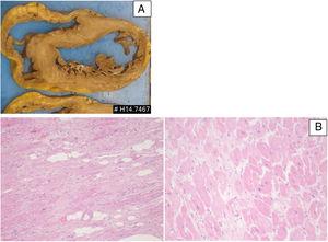 Patient 3: pathologic features of the explanted heart. (A) Macroscopy of heart section revealing features of dilated cardiomyopathy; (B) microscopic features (H&E stain) revealing interstitial fibrosis, hypertrophic cardiomyocytes and scattered adipocytes (left: low power; right: high power).