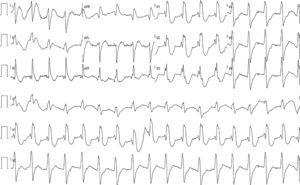 Eletrocardiograma de 12 derivações em ritmo próprio com QRS com padrão de bloqueio completo de ramo direito, intervalo PR no limite superior da normalidade, QTc: 405mseg.
