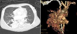 (A and B) Thoracic computed tomography scan showing a pulmonary arteriovenous malformation of the right lower lobe.