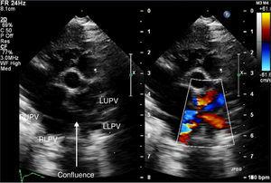 High parasternal short-axis echocardiographic views showing the individual pulmonary veins connecting to the confluent chamber. LLPV: left lower pulmonary vein; LUPV: left upper pulmonary vein; RLPV: right lower pulmonary vein; RUPV: right upper pulmonary vein.
