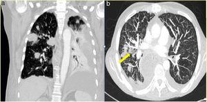 Chest computed tomography showing (A) multiple nodular opacities and (B) an incipient halo sign secondary to invasive pulmonary aspergillosis (yellow arrow).