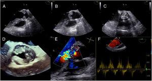 Transesophageal echocardiography: aortic valve vegetations (A, B) resembling the Mercedes Benz symbol (C, D); severe aortic regurgitation (E) (vena contracta 7 mm) and (F) (holodiastolic reverse flow in the descending aorta).