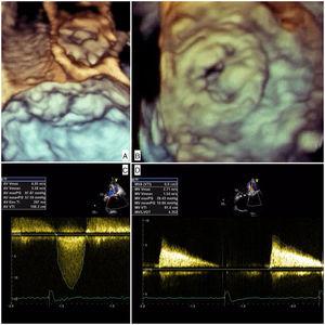 Degenerated aortic (A) and mitral (B) bioprotheses on three-dimensional echocardiography pre-procedure; increased aortic (C) and mitral (D) gradients measured during transesophageal echocardiography.