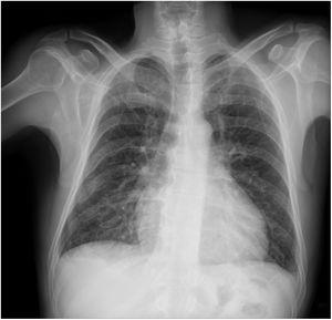 Chest X-ray showing increased cardiac area of a patient with Chagas cardiomyopathy.