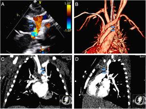 Sequential imaging approach to definitive diagnosis of a levoatrial cardinal vein in a neonate: pre-operative assessment. (A) Visualization of an abnormal ascending flow in the left superior vena cava position during the work-up echocardiogram for suspected coarctation of the aorta; (B-D) computed tomography confirming an abnormal venous connection between the left atrium and brachiocephalic vein (blue arrows).