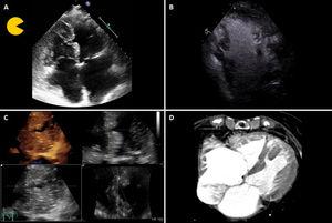 (A) Transthoracic echocardiogram (TTE) showing a partial loss of myocardial tissue in the mid segment of the interventricular septum; (B) contrast-enhanced TTE revealing a serpentine route through the septum to a small contained cavity; (C) three-dimensional TTE en face view of the half-moon shaped septal defect; (D) thoracic computed tomography conducted three years before, showing the partial ventricular septal defect.