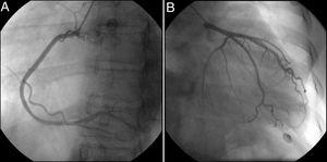 Invasive coronary angiography revealing no lesions. (A) Left anterior oblique view of the right coronary artery; (B) right anterior oblique view of the left coronary artery.
