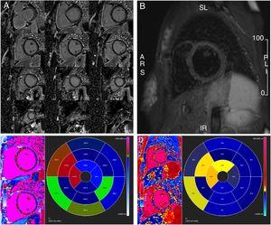 Cardiovascular magnetic resonance one month after the acute phase. (A) Gadolinium study with no late enhancement; (B) T2-weighted short tau inversion recovery imaging showing no residual macroscopic myocardial inflammation or edema; (C) T1 mapping study and (D) T2 mapping study showing low-grade septal edema.