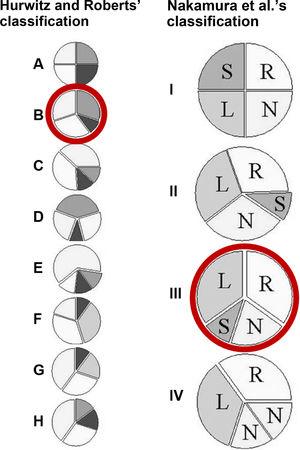 Left: the seven (A-G) anatomic types of quadricuspid valves described by Hurwitz and Roberts. Type H was added later by Vali et al.5. The most common is type B and the rarest is type D. Right: the simplified classification of Nakamura et al., based on the position of the supernumerary cusp. L: left coronary cusp; N: non-coronary cusp; R: right coronary cusp; S: supernumerary cusp. Red circles identify the case presented in this report.