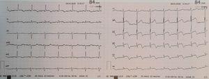 Electrocardiogram at admission performed in the emergency ward with acute coronary syndrome: sinus rhythm, with ST-segment elevation in leads V2-V6.