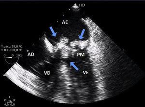 Ecocardiograma transesofágico com imagens sugestivas de vegetações móveis em prótese valvar mitral. AE ‐ átrio esquerdo; VE ‐ ventrículo esquerdo; AE ‐ átrio direito; VD ‐ ventrículo direito; PM ‐ prótese biológica mitral. Setas: Vegetações em prótese valvar mitral.