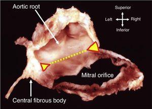 Dissection showing how part of the annulus is formed by the region of fibrous continuity with the leaflets of the aortic valve (dotted yellow line). The ends of this area of continuity (triangles) are the fibrous trigones that anchor the valve complex to the roof of the left ventricle. The right trigone merges with the membranous septum to form the central fibrous body (from 10).
