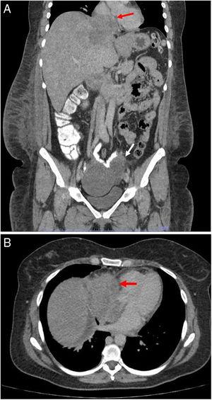 A: Coronal thoracic computed tomography showing left complex adnexal mass (white arrow) and lobulated hepatic mass with compression and displacement of inferior vena cava and right atrial extension (red arrow). B: Axial thoracic computed tomography showing mass with right atrial extension (red arrow).
