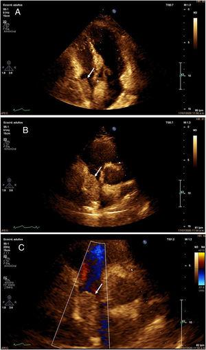 A: Transthoracic echocardiography showing echo-dense mass of 32 mm×31 mm, area 9.8 cm2 within right atrium suggestive of mass or intracavitary thrombus (white arrow). C: Transthoracic echocardiography showing mass within right atrium (white arrow). B: Transthoracic echocardiography showing restriction to color flow Doppler (white arrow).