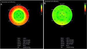 Bull's-eye plots of left ventricular myocardial work efficiency derived by two-dimensional transthoracic echocardiography. (A) In the acute phase, there was significant reduction in regional values of basal segments (red-coded areas); (B) on review one month later, basal segments had recovered. Almost all myocardial walls contributed equally to left ventricular ejection, and global work efficiency (GWE) increased from 76% to 92%. ANT: anterior wall; ANT_SEPT: anteroseptal wall; BP: blood pressure; GCW: global constructive work; GLS: global longitudinal strain; GWI: global work index; GWW: global wasted work; INF: inferior wall; LAT: lateral wall; POST: posterior wall; SEPT: septal wall.