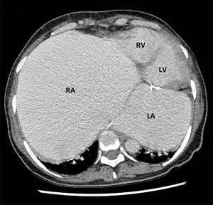 Computed tomography showing giant right and left atria, the right atrium being much more dilated. The ventricles are normal in size and function. LA: left atrium; LV: left ventricle; RA: right atrium; RV: right ventricle.