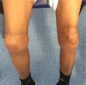 Artropatia bilateral dos joelhos.