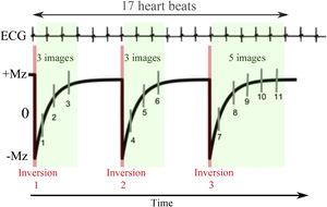 Scheme of synchronisation of the MOLLI method with the ECG. The acquisition represented is MOLLI 3(3)3(3)5 in which three inversions are performed. The first two are followed by three images with different inversion times separated from each other by a heartbeat and the last inversion with five images. Between inversions there is a magnetization recovery period which is represented inside the brackets and which corresponds to three heartbeats. In this way, the acquisition lasts 17 heartbeats, obtaining 11 images in total. These are ordered according to the time elapsed since the respective inversion, in order to perform the adjustment of the exponential model. Legends: ECG: electrocardiogram; Mz: longitudinal magnetization.