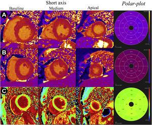 T1 and VEC maps (short basal, middle, apical and respective polar-plots) in different pathological situations: A - T1 maps of a patient with hypertrophic cardiomyopathy and mean myocardial T1 time of 1085 ms (reference 950-1050 ms); B - T1 maps of a patient with cardiac amyloidosis and mean myocardial T1 time of 1170 ms (reference 950-1050 ms); C - VEC maps of a professional football player with mild left ventricular hypertrophy considered physiological and with mean VEC of 24%.