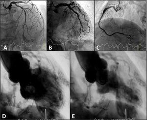 Cardiac catheterization during primary percutaneous coronary intervention. (A-C) Coronary angiography with non-obstructive coronary artery disease; (D-E) ventriculography showing wall motion abnormalities in apical segments of the anterolateral and inferior walls, compatible with Takotsubo wall motion abnormality pattern.