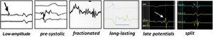 Examples of local abnormal ventricular activities recorded during electrophysiological substrate mapping in sinus rhythm.