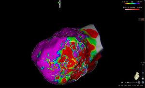 Conduction channels visualized in high-density electroanatomic mapping by adjusting the color threshold on the voltage map (left lateral view) in an ischemic cardiomyopathy patient.