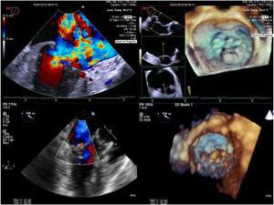 Two and three-dimensional transesophageal echocardiogram is essential for off-pump transapical neochord implantation planning and real-time guiding. Left upper panel: baseline severe mitral regurgitation jet, eccentrically oriented toward interatrial septum, due to posterior leaflet prolapse. Right upper panel: Surgical view of mitral valve from an atrial perspective, showing P2 prolapse (arrow). Left lower panel: Mild grade mitral regurgitation after two neochordae implantation. Right lower panel: Three-dimensional view of mitral valve following neochordae implantation confirmed correction of P2 prolapse.