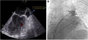 A. Transesophageal echocardiography imaging of the left atrial appendage in atrial fibrillation before ablation. Blood flow velocities (on the right top) showed low peak emptying velocities (<40 cm/s). B. Fluoroscopic image showing contrast injection with complete occlusion of the left atrial appendage (white arrows) by the inflated cryoballoon. Advance Achieve 2 circular catheter is placed inside the left atrial appendage (left anterior oblique view).