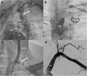 A. Left coronary angiography showing retrograde flow from the coronary tree through the mammary artery bypass graft (arrow). B. Left subclavian angiography revealed total occlusion proximal to the left internal mammary artery graft to the first diagonal artery. C. Left common carotid angiography demonstrated the total occlusion of the carotid-subclavian bypass graft (arrow). D. Digital subtraction angiography of the left subclavian artery after stent placement showed successful treatment of the subclavian occlusion. D1: first diagonal artery; LAD: left anterior descending artery; LCCA: left common carotid artery; SA: subclavian artery.