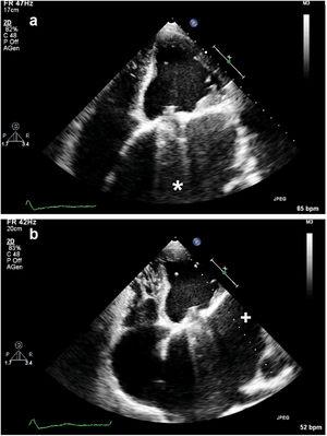 Transthoracic echocardiogram: (a) 4-chamber view showing a huge left atrium (*); (b) giant left atrial appendage (+).