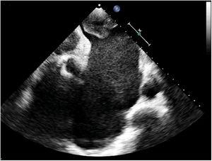 Transthoracic echocardiogram: 4-chamber off-axis view, showing severe left atrial appendage enlargement with smoke and a massive thrombosis of the fundus.