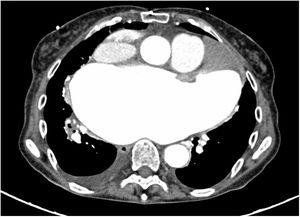 Computed tomography of the chest, axial view, confirming the transthoracic echocardiographic findings.