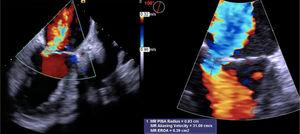 Transesophageal echocardiography under intra-aortic balloon pump support. Mid-esophageal two-chamber view showing asymmetric tethering of mitral valve leaflets due to posterior leaflet restriction and severe mitral regurgitation (EROA 0.39 cm2).