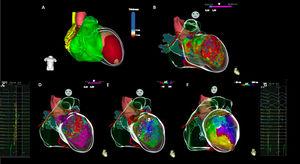 High-density multielectrode mapping and real-time image integration in a case of post-anterior myocardial infarction ventricular tachycardia. (A) Real-time image integration using ADAS 3D LV software, demonstrating an anterior and apical left ventricle thickening (≤5 mm). (B) A large anterior and apical scar (<1.5 mV) is shown on endocardial bipolar voltage map, revealing good correlation with RTII. (C) Local abnormal ventricular activities were recorded with a multielectrode catheter (Pentaray). (D) Voltage map during sinus rhythm. (E) Activation map during sinus rhythm depicting late activation on de left ventricle anterior medial segment. (F) Clinical ventricular tachycardia activation map, depicting a slow conducting isthmus on the LV anterior medial segment. (G) Mid-diastolic electrograms recorded with multielectrode catheter (Pentaray) on the left ventricle anterior medial segment, during ventricular tachycardia. ECG: Electrogram; LV: Left ventricle; LAVAs: Local abnormal ventricular activities; RTII: Real time integration imaging.