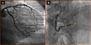 Coronary angiography after multiple percutaneous coronary artery revascularizations (A, *) showing chronic occlusion of the posterior descending artery (B, arrowhead).