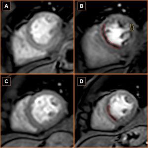 Stress and rest perfusion cardiac magnetic resonance (CMR) sequences showing improved perfusion in the left ventricular septal wall perfusion defect (red area) and resolution of the left ventricular lateral wall perfusion defect (yellow area). (A) Baseline rest perfusion CMR; (B) baseline stress perfusion CMR; (C) 18-month follow-up rest perfusion CMR; (D) 18-month follow-up stress perfusion CMR.