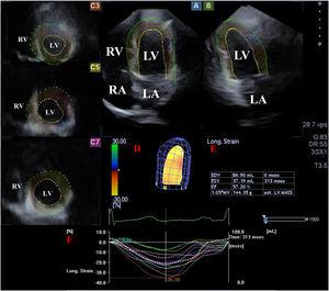Images from three-dimensional (3D) speckle-tracking echocardiographic analysis in apical 4-chamber view (A), apical 2-chamber view (B) and apical (C3), mid-ventricular (C5) and basal (C7) left ventricular (LV) short-axis views together with a 3D virtual model of the LV (red D), LV volumetric data on the cardiac cycle (red E) and time – LV segmental and global strain curves (colored lines) with a time – LV volume changes curve (dashed line) during the cardiac cycle (red F). LA: left atrium; LV: left ventricle; RA: right atrium; RV: right ventricle.