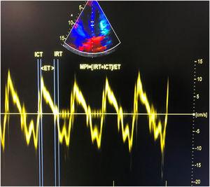Calculation of tissue Doppler-derived left ventricular myocardial performance index. ET: ejection time; ICT: isovolumic contraction time; IRT: isovolumic relaxation time.