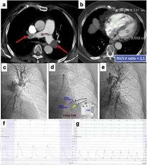 This is the case of an 86-years old woman who had a recent ischemic stroke and was admitted with an acute intermediate-high-risk PE, catheter-directed therapy proposed due to respiratory failure (paO2/FiO2 ratio=170), with no response to parenteral anticoagulation. a) and b) Axial contrast enhanced computed tomography at time of diagnosis illustrates central extensive bilateral thrombus (red arrows) and huge dilatation of right ventricle (RV/LV ratio of 2.1). c) Selective pulmonary angiography confirms obstruction of left inferior lobar artery and lingula. d) Continuous aspiration mechanical thrombectomy was performed with Indigo® CAT8. A Penumbra Indigo System Separator SEP8 device was used through the aspiration catheter to facilitate clot aspiration by preventing the catheter from clogging in the extensive thrombus. e) Post-procedure we observe a near restoration of the normal perfusion in the left lung. f) and g) There was a decrease in systolic and mean pulmonary artery pressure of 65 and 33 mmHg pre-procedure, respectively, to 42 and 25 mmHg post-procedure. PaO2/FiO2 ratio increased to 371 at 48 hours after intervention.